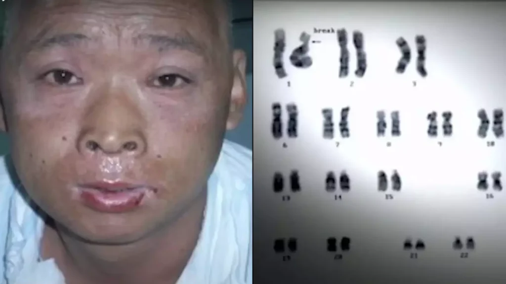 Hisashi Ouchi during treatment in October 1999. Despite stem cell transplants and transfusions, the radiation damage to his DNA and skin continued to worsen.